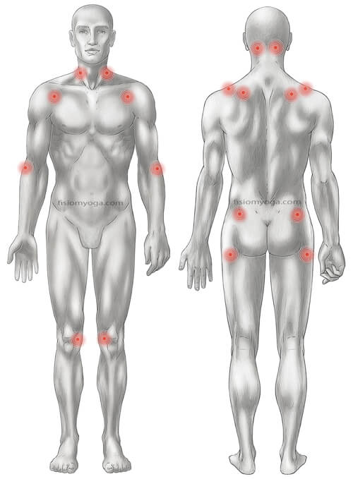fibromialgia fibromialgia