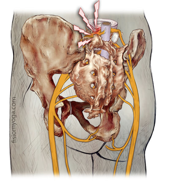 pinament ciática hernia