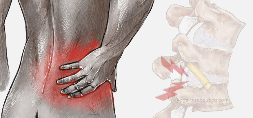 Dolor lumbar frecuente Dolor lumbar frecuente