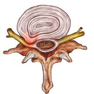 Protrusión discal dolor lumbar, Protrusión discal