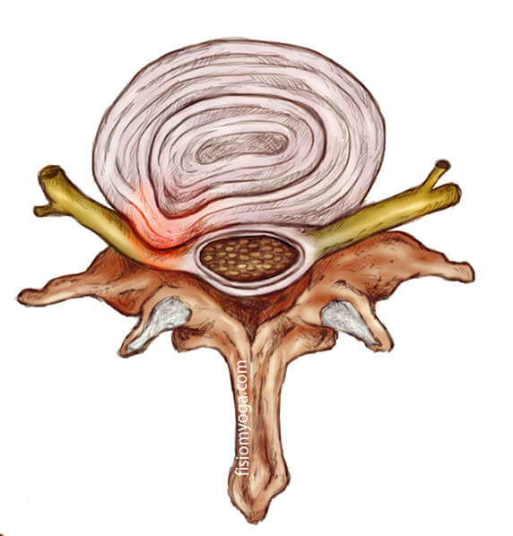 Protrusión discal dolor lumbar, Protrusión discal