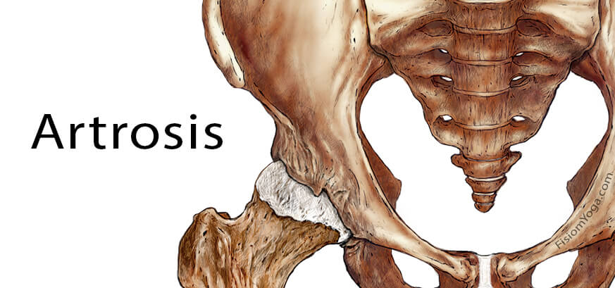 Artrosis Artrosis
