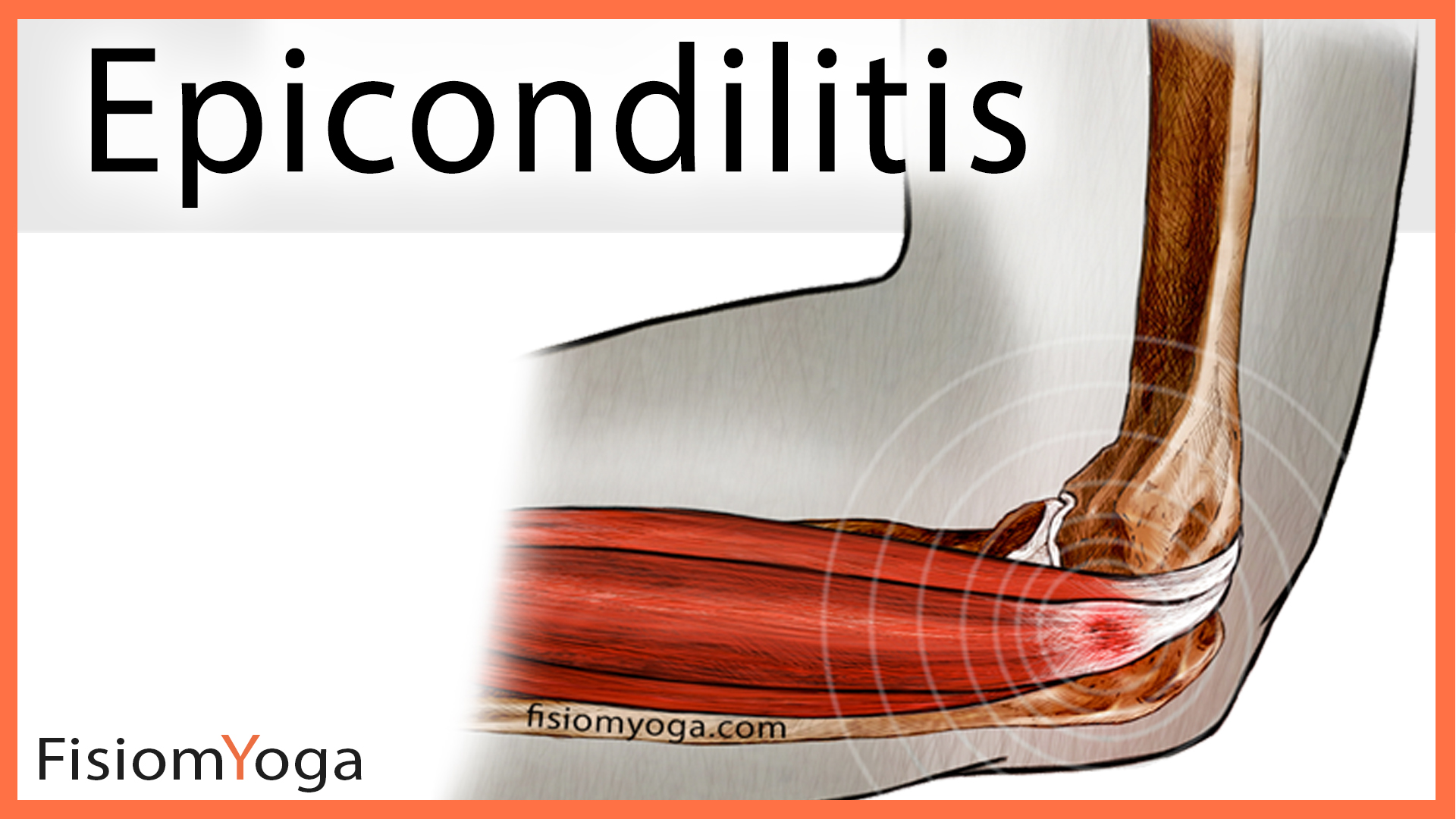 Epicondilitis
