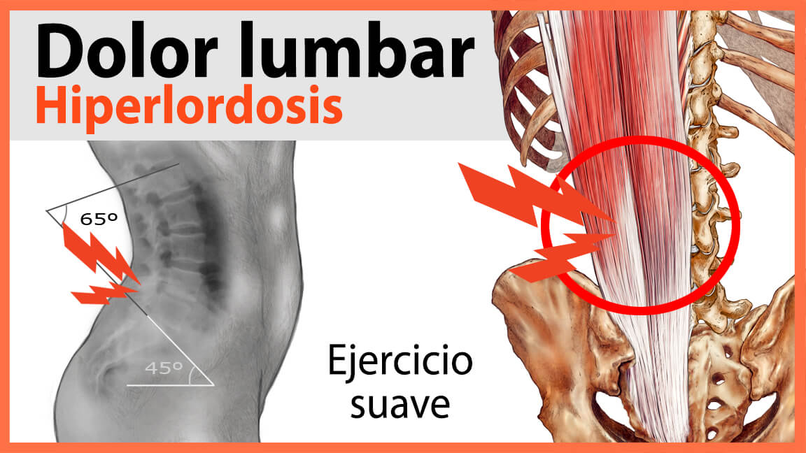 Ejercicio para Hiperlordosis Lumbar Ejercicio para Hiperlordosis Lumbar