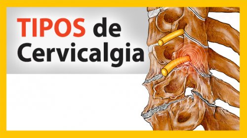 03-tipos-de-cervicalgia-petit tipos de dolor cervical