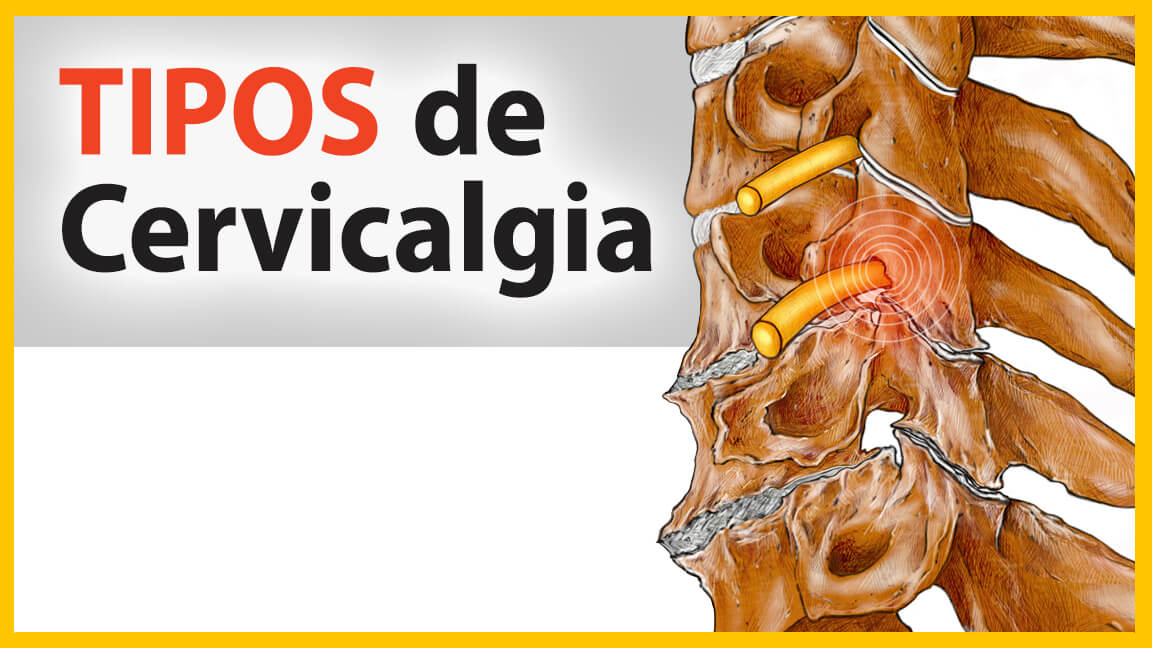 Tipos de cervicalgia Tipos de cervicalgia