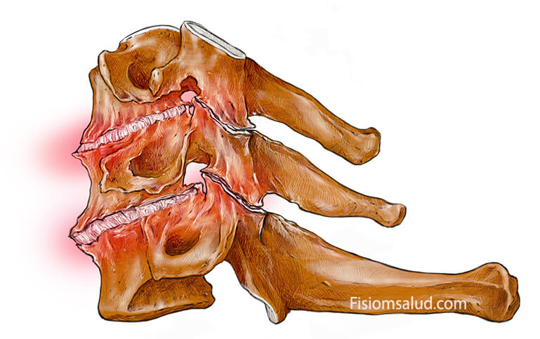 dolor cervical artrosis