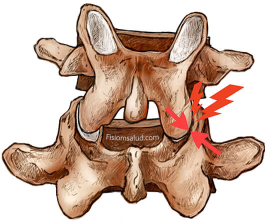 cervicalgia por bloqueos cervicales