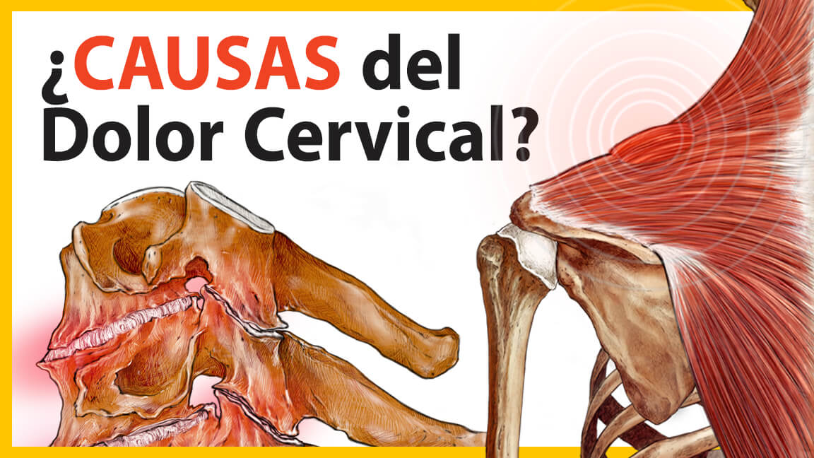 ¿Cuál es la causa de la cervicalgia? ¿Cuál es la causa de la cervicalgia?