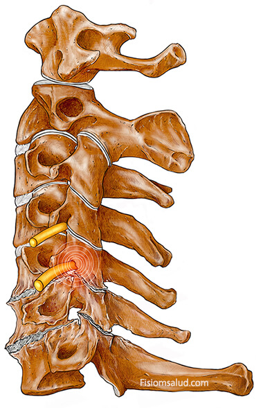 Tipos de Cervicalgia - Cronificación del Dolor
