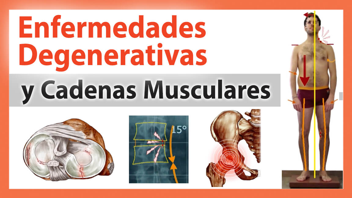 Enfermedades Degenerativas Enfermedades Degenerativas