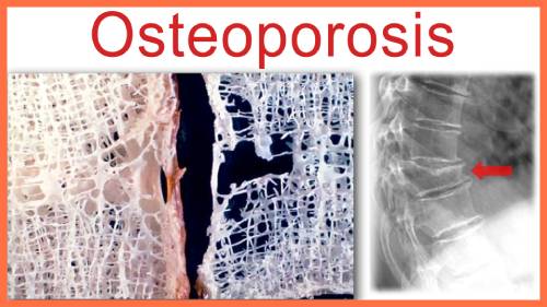 Cuidados para prevenir la Osteoporosis Cuidados para prevenir la Osteoporosis