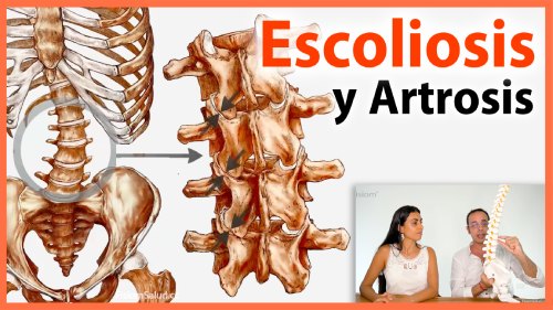 Escoliosis y Artrosis Escoliosis y Artrosis