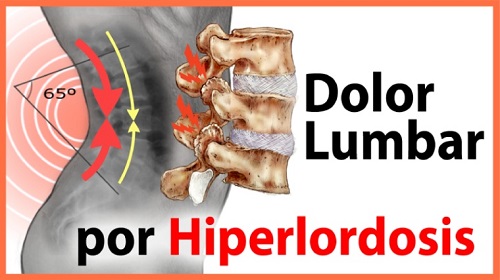 Dolor Lumbar por Hiperlordosis Dolor Lumbar por Hiperlordosis