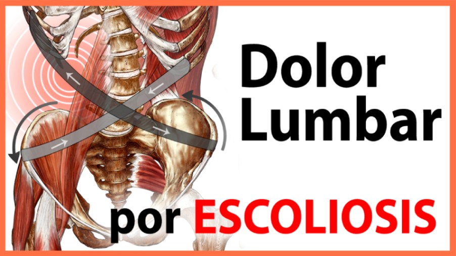Dolor Lumbar y Escoliosis Dolor Lumbar y Escoliosis