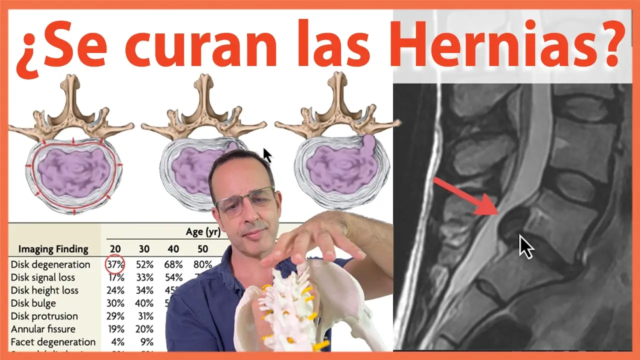 ¿Se curan las hernias discales? ¿Se curan las hernias discales?
