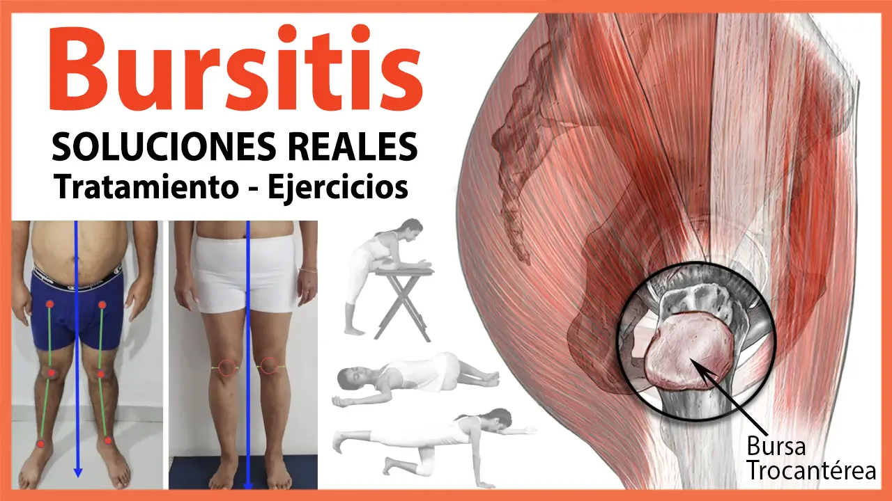 La Bursitis Trocantérea La Bursitis Trocantérea